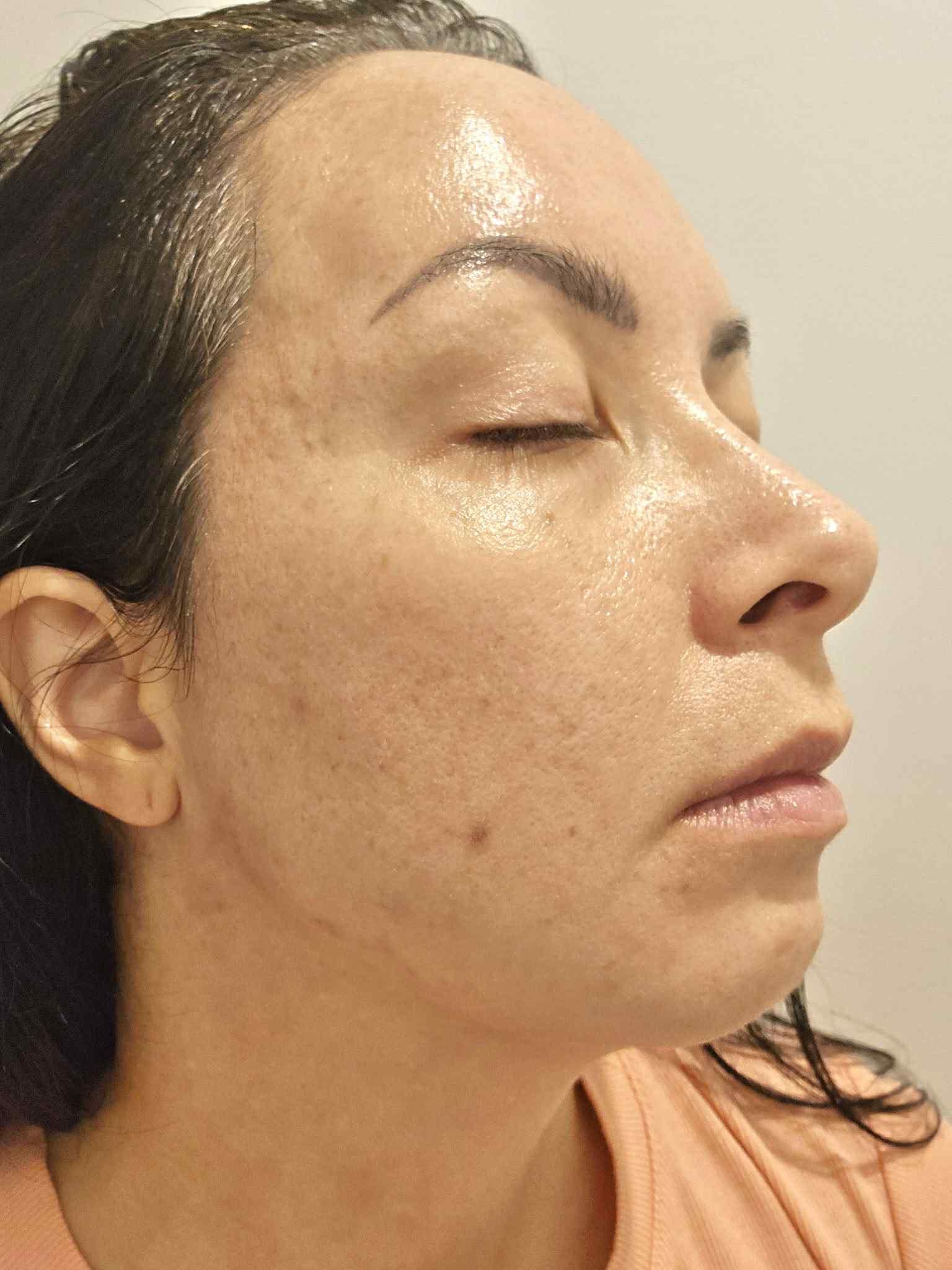 Client's skin after treatment at Nin's Beauty Salon showing clearer, more even and radiant complexion