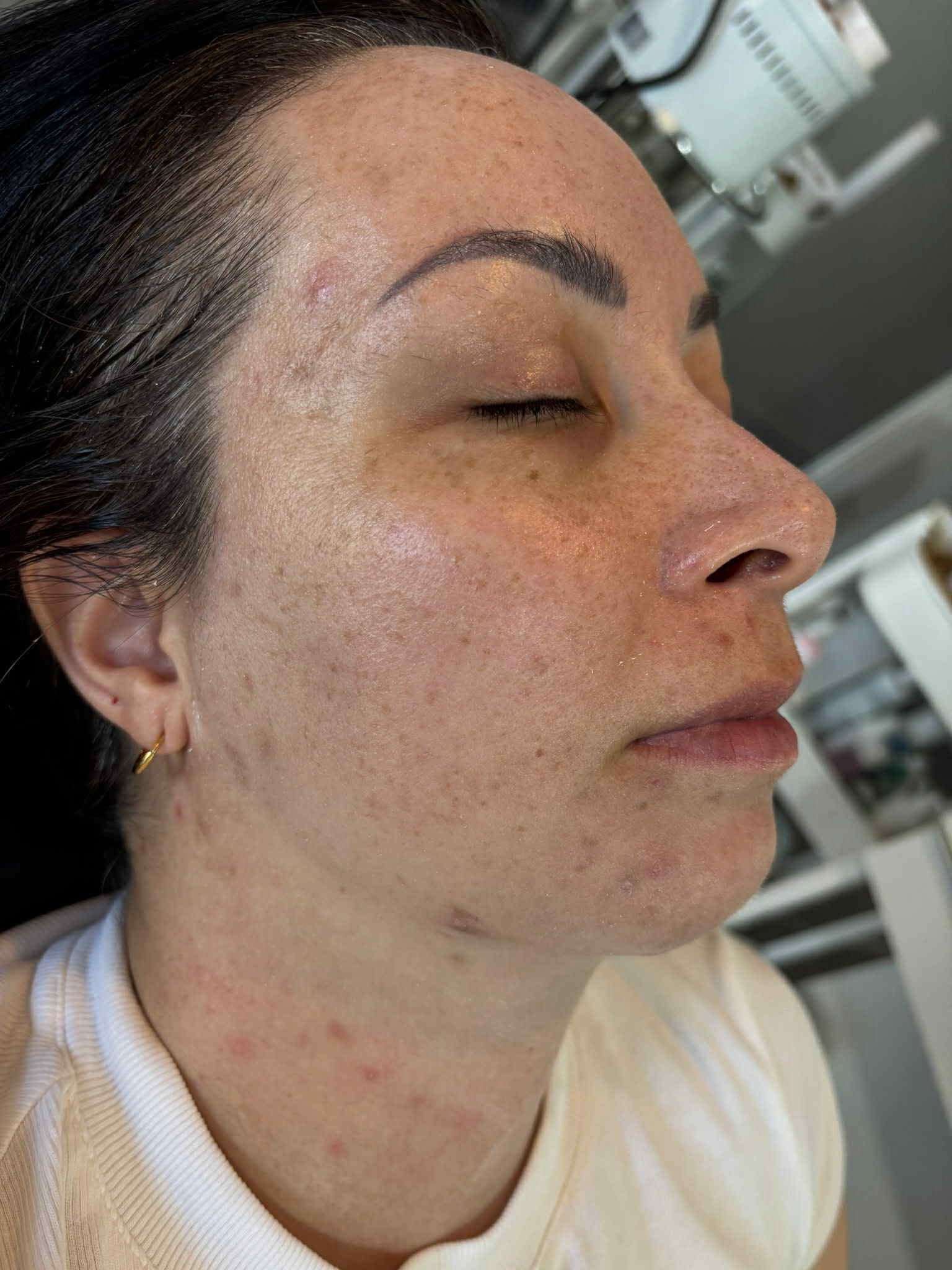 Client's skin before treatment at Nin's Beauty Salon showing pigmentation, freckling and uneven texture